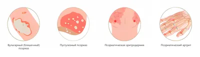 Псориаз: симптомы, причины, виды, стадии, начало, профилактика