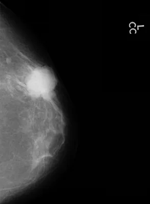 Рак груди: как обнаружить, какие симптомы и можно ли вылечить