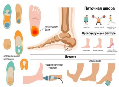 Шпора пяточная