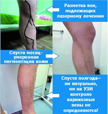 Удаление пигментации кожи: сравнение эффективности процедур - клиника  лазерной косметологии в Москве