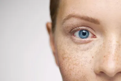 изображение до и после темных пятен мелазмы шрам акне пигментация кожи  лечение лица на лице азианка. Стоковое Фото - изображение насчитывающей  пигмент, взорвать: 216248056