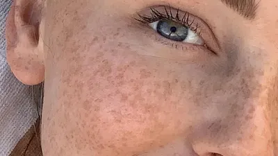 изображение до и после старения темное пятно мелазма пигментация кожи лица  лечение омоложения на лице азиатки. Стоковое Фото - изображение  насчитывающей микстура, концепция: 216247416