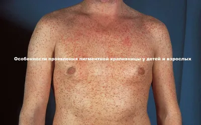 Лечение крапивницы в Киеве — Derma.ua