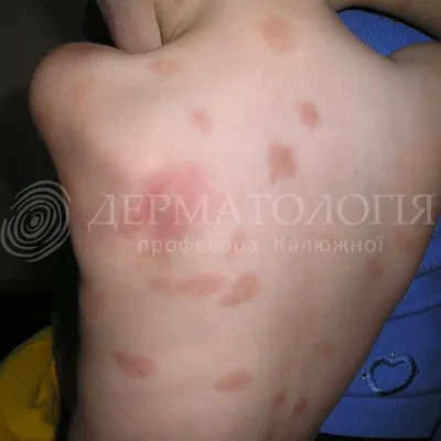 Мастоцитоз кожи - диагностика и лечение в частной клинике в Киеве