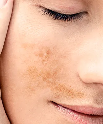 Пигментация кожи: причина и лечение | Косметические средства для  профилактики