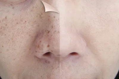 Удаление пигментных пятен на лице, теле, ладонях - Клиника актуальной  косметологии Рязани