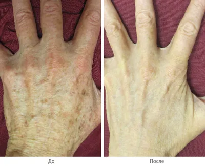 Как отличить пигментные пятна от рака кожи | МегаТюмень | Дзен