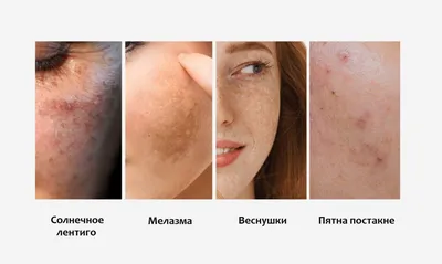 Урок макияжа: как замаскировать на лице пигментное пятно? | Beauty Insider