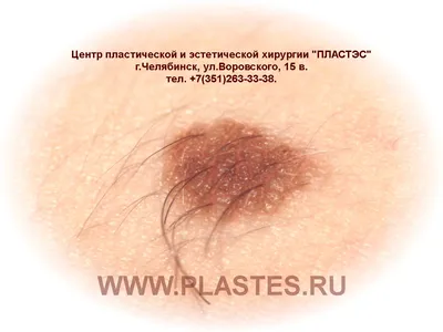dr_sadykova_ - 🔬Невус (пигментное пятно, пигментный невус, меланоцитарный  невус) – доброкачественное новообразование, которое в большинстве случаев  является врожденным пороком развития кожи. На ограниченном участке  образуется скопление особых клеток ...