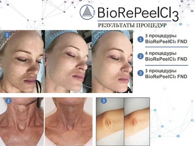 Химический пилинг Biorepeel в клинике косметологии в Санкт-Петербурге