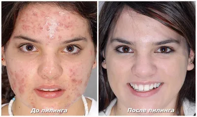 Миндальный пилинг лица: фото до и после, отзывы специалистов, как проходит  процедура