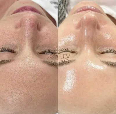 Фото до и после алмазного пилинга лица у косметолога