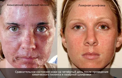 DERMAQUEST » Как убрать ожоги и красноту после пилинга| Статьи | Отзывы |  Купить