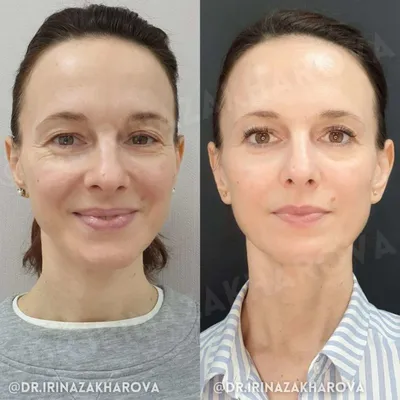 Ультразвуковая чистка лица: фото до и после, отзывы специалистов, как  проходит процедура