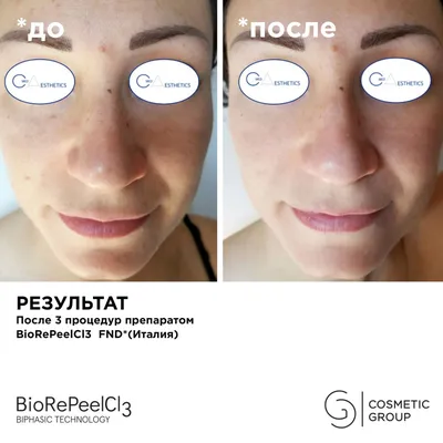 Вакуумная чистка лица HydraFacial в Москве: цены, фото до и после, отзывы |  Стоимость вакуумной чистки лица HydraFacial в клинике Seline