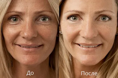Химический пилинг для лица и тела SkinLazerMed