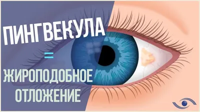 Александр Тесленко - Желтоватое образование на белке глаза… Что это? Это  опасно? Как лечить? На картинках вы видите разные варианты того, что  называется «пингвекула». Что это? Это разрастание слизистой оболочки глаза  (нарост