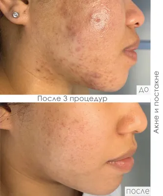 DERMAQUEST » Миндальный пилинг с Азелаиновой кислотой и Гибискусом | Для  проблемной жирной кожи против акне | Отзывы | Купить