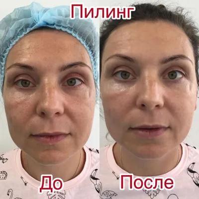 Пилинг лица и тела для сухой, жирной, чувствительной кожи — цена процедур в  СПб