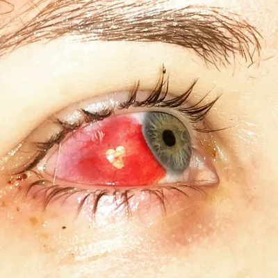 Пирсинг глаза или глазные платиновые имплантанты | FunTattoo.ru