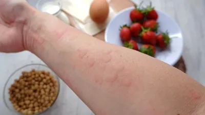 Прыщи аллергии на коже ребенка. Пищевая аллергия Стоковое Фото -  изображение насчитывающей кожа, природа: 203529070