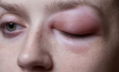 Аллергия: как не перепутать? | AnnaMama