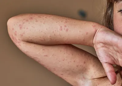 Симптомы аллергии: как проявляется и выглядит аллергия
