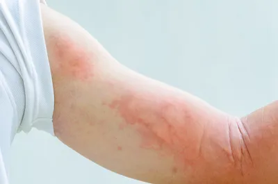 Прыщи аллергии на коже ребенка. Пищевая аллергия Стоковое Изображение -  изображение насчитывающей заболевания, зуд: 204332927