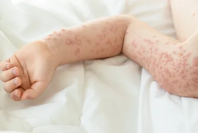 Аллергия на коже: проявления, симптомы, лечение - Все про аллергию