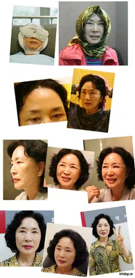 Корейская пластическая хирургия с фото «до» и «после» (22 фото) » Триникси