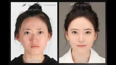 Пластическая хирургия в Корее / До и после / Plastic Surgery in Korea /  Before and After HD - YouTube