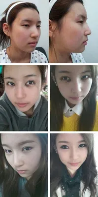 До» и «После» корейских пластических хирургов: правда или фотошоп? | Beauty  Insider
