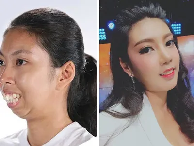 Корейские пластические хирурги исправили девушке деформацию челюсти: фото до  и после | Glamour | Glamour