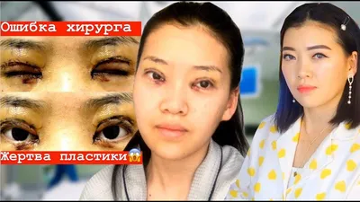 Allasia Кыргызстан - Лечение в Корее - ♻️ 76% женщин Южной Кореи🇰🇷  обращаются к пластическим хирургам. ⠀ ☝По данным опросов 90 % молодых  корейских женщин планируют визит в клинику с целью проведения