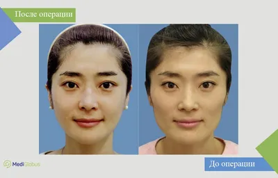 Сколько стоит новый нос в Южной Корее? | theGirl