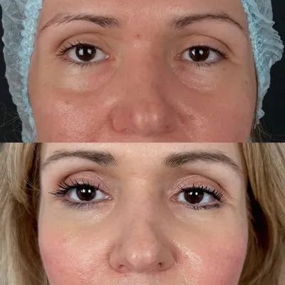 Бефаропластика лица и глаз: как убрать нависшее веко и мешки под глазами