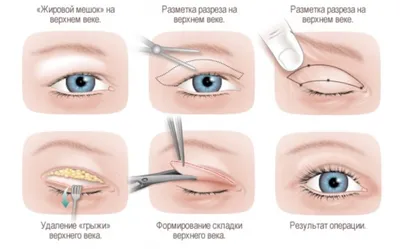 Лазерная блефаропластика век в СПБ / Пластика верхних и нижних век лазером