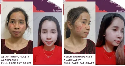 Вишневые губы», уменьшение челюсти, пластика ноздрей: какие операции  популярны в Южной Корее - Рамблер/женский