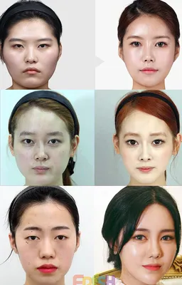 Невероятные результаты пластических операций в Южной Корее, покорившие мир  + фото \"до и после\" | Moydoms.ru | Дзен
