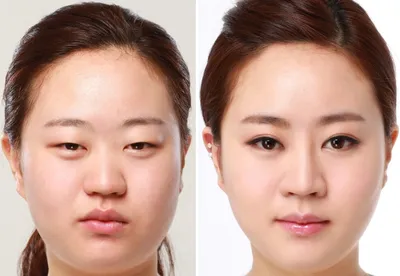 Корейские пластические хирурги исправили девушке деформацию челюсти: фото  до и после | Glamour | Glamour