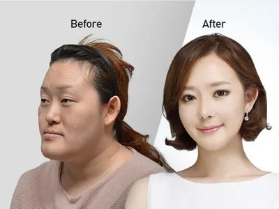 В Южной Корее пластические хирурги меняют лица пациентов до полной  неузнаваемости