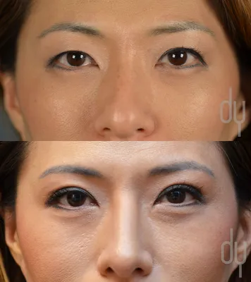 Пластическая операция азиатских глаз и удалении эпикантуса