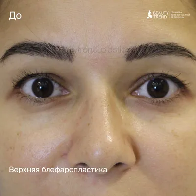 Пластика век в Новороссийске, лазерная блефаропластика глаз, цена операции  по контурной пластике век в микрохирургии - Клиника МХК