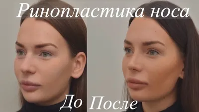 Пластика носа фото до после фото