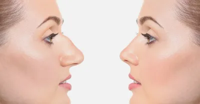 Ринопластика: пластика носа, фото до и после ринопластики, отзывы