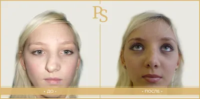 Фото до и после ринопластики - фотографии результатов по пластике носа