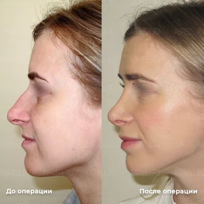 Ринопластика: фото до и после пластики носа в СМ-Клиника