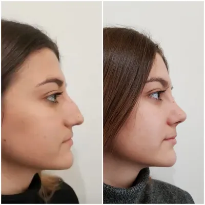 Пластика носа с горбинкой | Фото до и после | Запись 1091