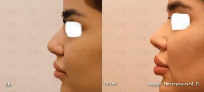 До и после ринопластики в... - JW Korea - Красота и здоровье | Facebook