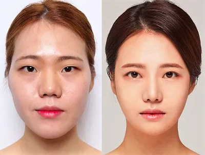 Ринопластика в Корее ❤️ Корейский нос | Сколько стоит ринопластика в Корее